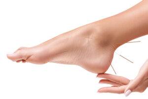 Weibliche Beine mit einfügen Akupunkturnadeln. Akupunktur Behandlung Konzept.